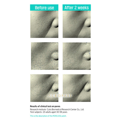 Acropass Poreless Microneedle Bubble Pack (2 Cleansing Pouch + 4 Patches)