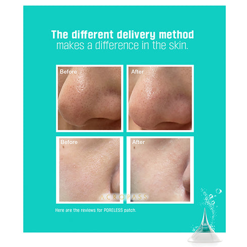 Acropass Poreless Microneedle Bubble Pack (2 Cleansing Pouch + 4 Patches)