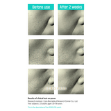 Acropass Poreless Microneedle Bubble Pack (2 Cleansing Pouch + 4 Patches)